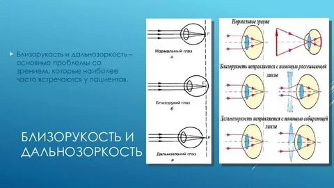 Близорукость и дальнозоркость как исправить