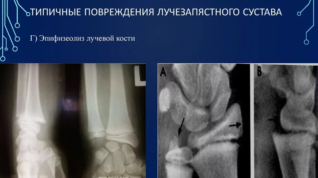 остеоэпифизеолиз лучевой кости
