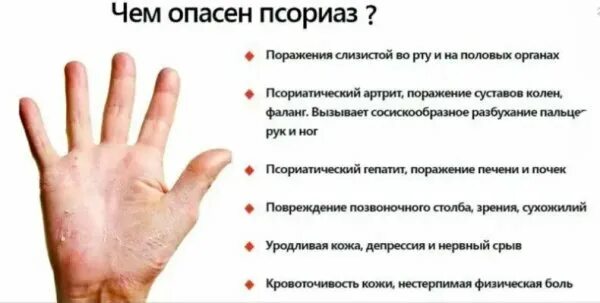 Псориаз