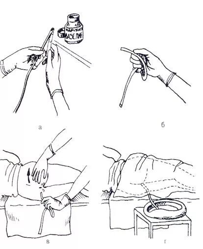 Алгоритм постановки очистительной клизмы сестринское. Очистительная клизма алгоритм. Постановка гипертонической клизмы схема. Газоотводная трубка алгоритм. Постановка газоотводной клизмы алгоритм.
