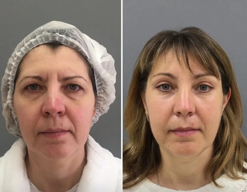 спейслифтинг мендельсона лица. подтяжка лица хирургическим путем спб. подтяжка лица хирургическим путем до и после. эндоскопическая подтяжка верхней трети. операция фейслифтинг до и после.