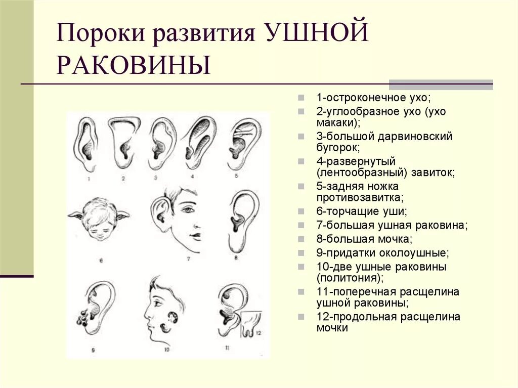 Почему уши разные. Пороки развития ушной раковины. Аномалии ушной раковины у новорожденного. Аномалии строения ушной раковины. Аномалии развития наружного уха у детей.