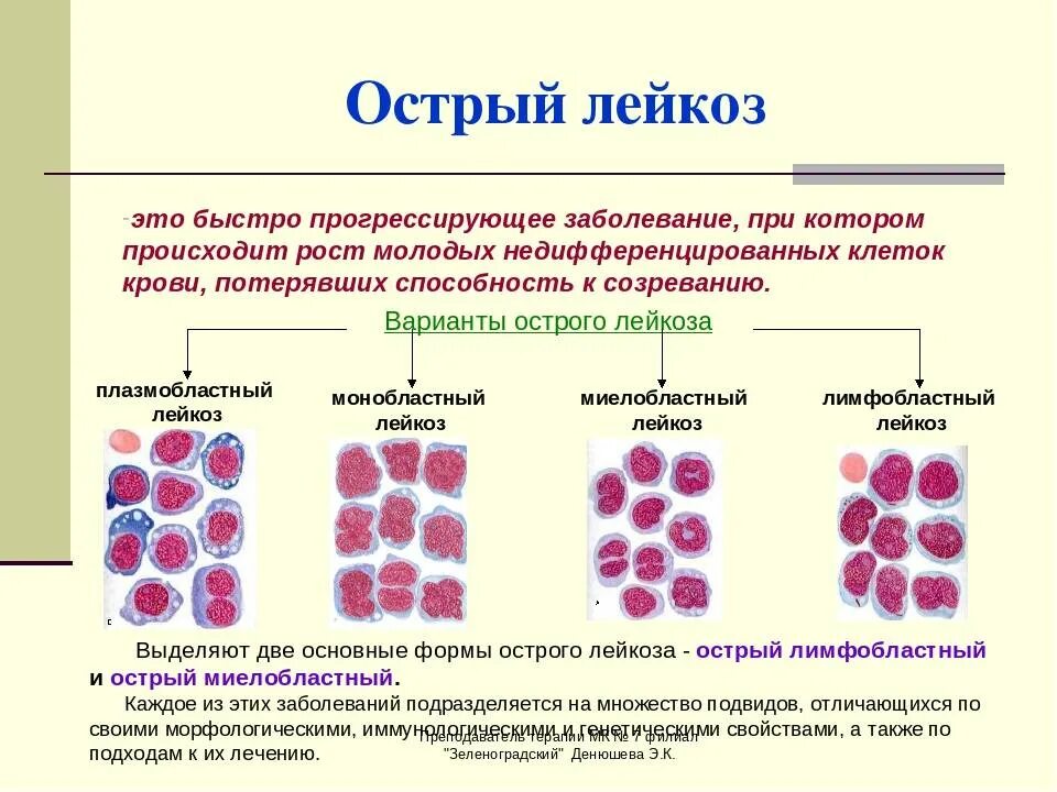 Злокачественные заболевания крови. Недифференцируемый острый миелобластный лейкоз. Острый миелоидный и лимфобластный лейкоз. Острый лимфобластный лейкоз морфология. Острый лейкоз классификация картина крови.