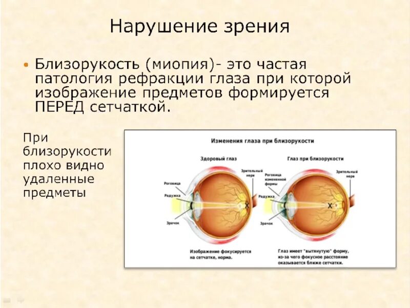 Анализаторы биология 8 класс видеоурок. Где фокусируется изображение при близорукости. Хрусталик при близорукости. Близорукость фокус перед сетчаткой. Анализаторы биология.