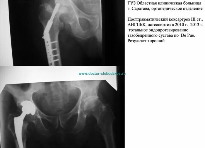 Посттравматический коксартроз. Коксартроз 2 степени рентген. Коксартроз тазобедренного сустава кт. Коксартроз тазобедренного сустава степени на кт. Коксартроз к какому врачу обратиться