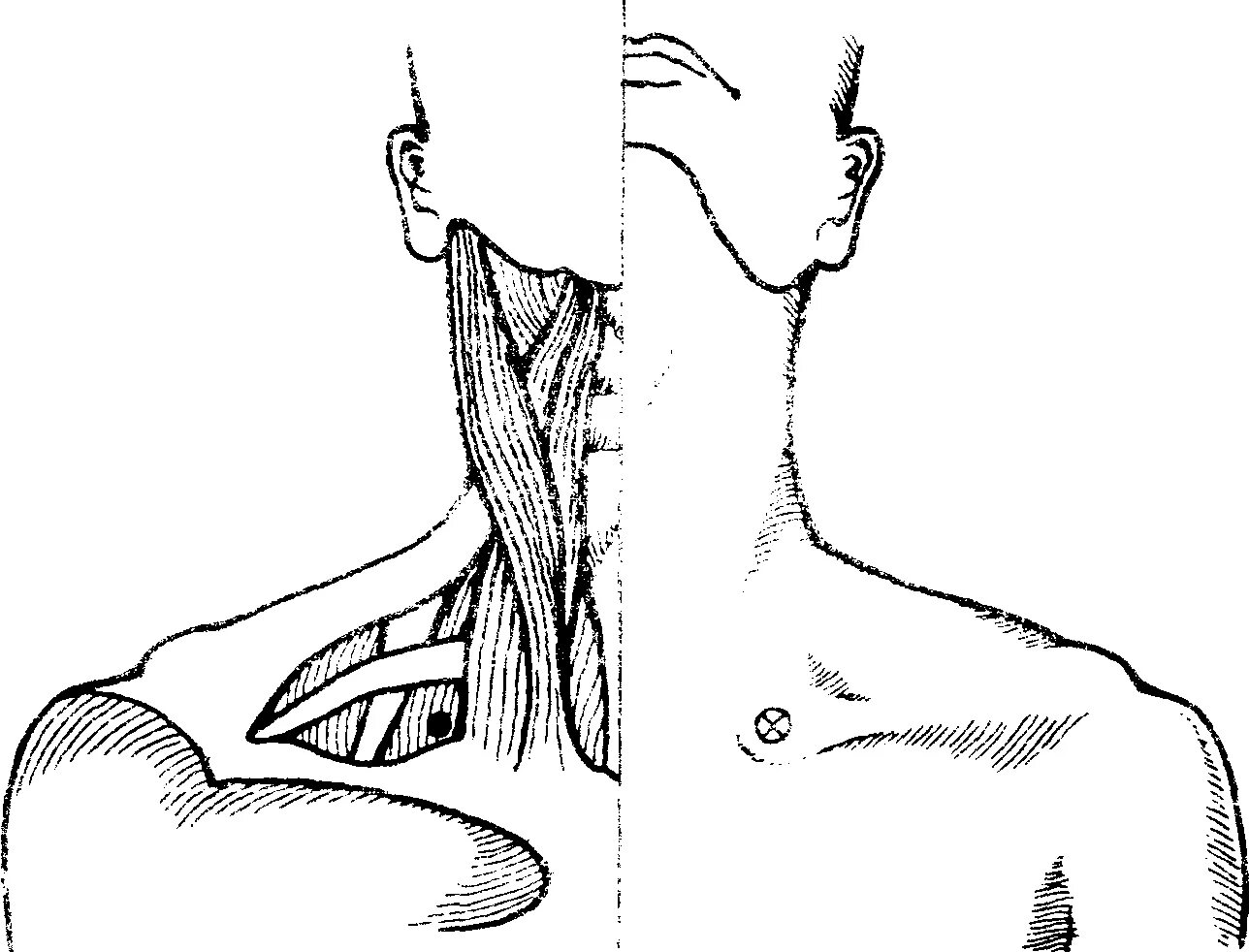 Лестничные мышцы анатомия. Лестничные мышцы (латеральная группа). Синдром лестничной мышцы. Скаленус синдром блокада.
