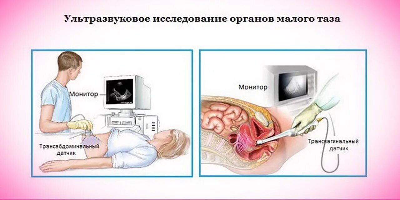 Что нельзя делать гинекологу. УЗИ малого таза трансабдоминально. УЗИ матки трансвагинальный датчик. УЗИ малый таз трансабдоминально. Ультразвуковое исследование матки и придатков трансабдоминальное.