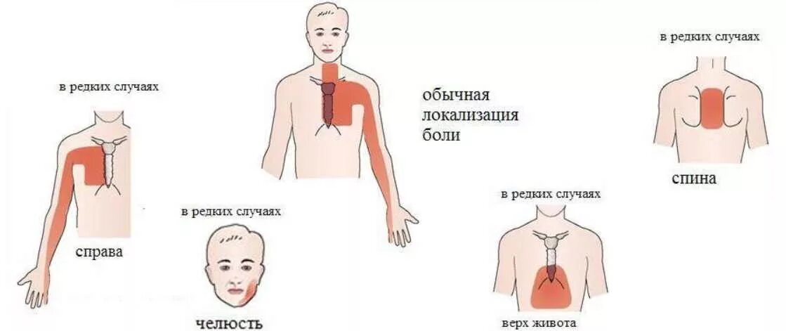 Болт в сердце симптомы. Боли в сердце симптомы. Иррадиация боли при стенокардии.