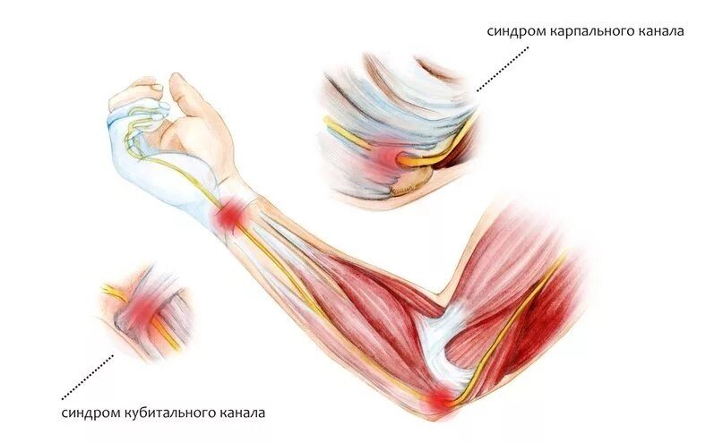 Туннельный синдром локтевого нерва на кисти. Туннельный синдром локтевого сустава. Кубитальный туннельный синдром локтевого нерва. Кубитальный канал локтевого сустава.