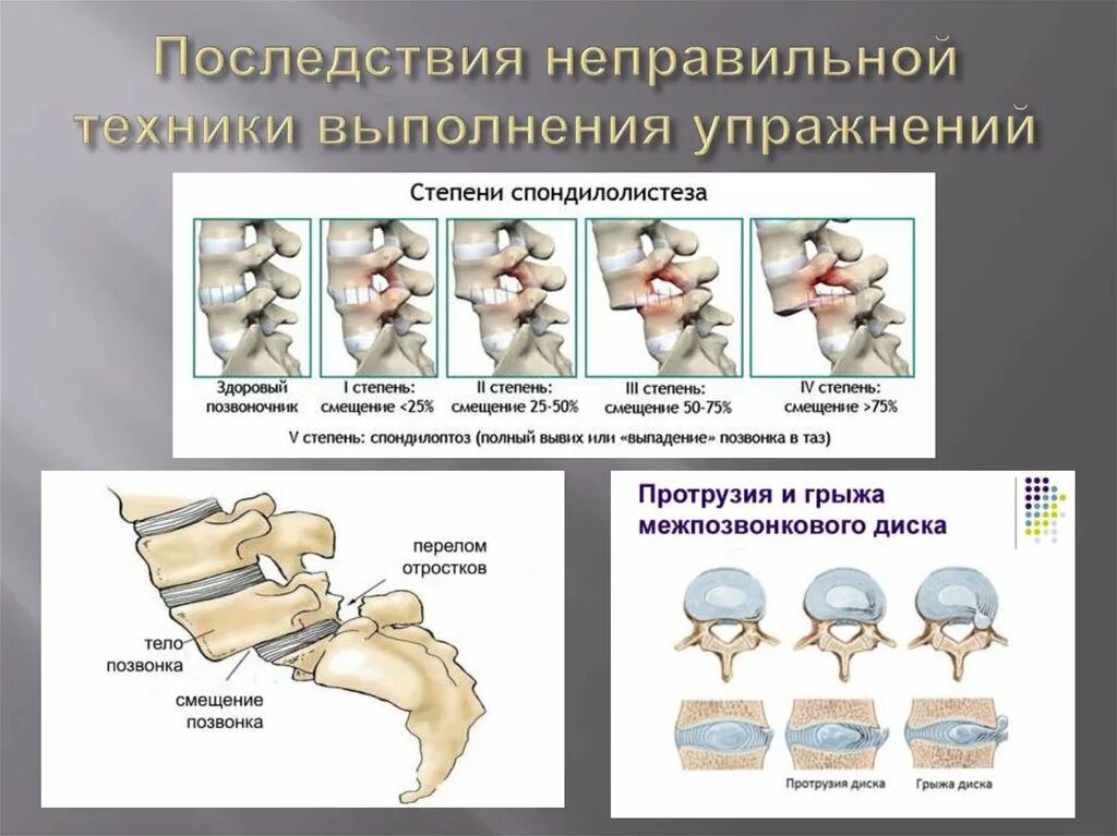 Последствия неправильного. Вывих шейного позвонка классификация. Вывих позвонка. Классификация смещения позвонков. Вывихи и подвывихи позвонков.