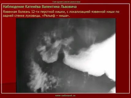 Язвенная болезнь 12 кишки мкб