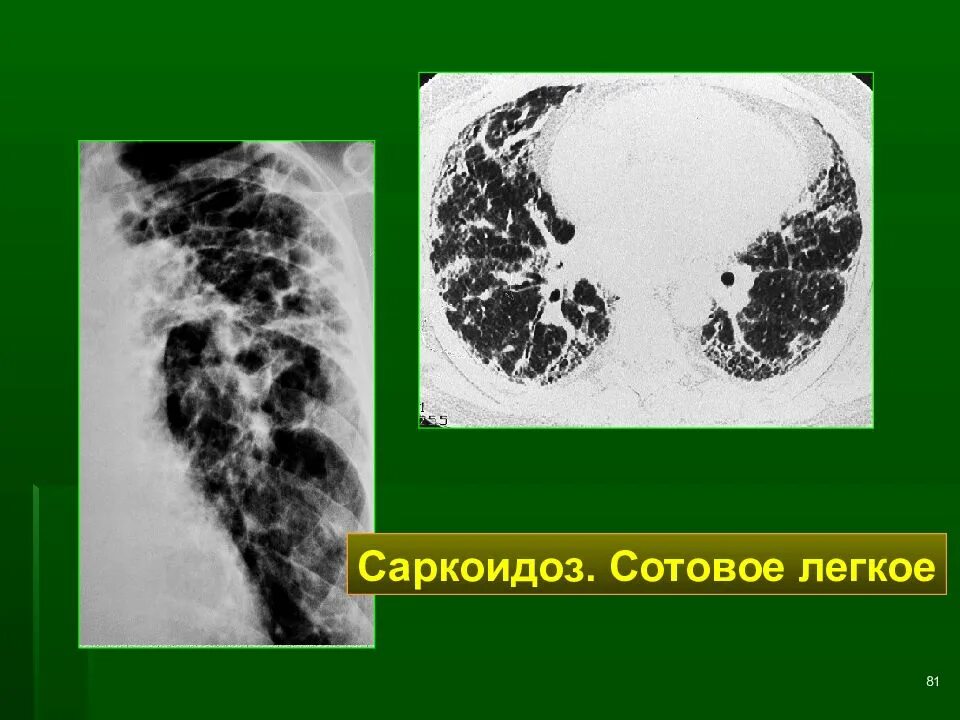 Лучевые заболевания легких. Сотовое легкое саркоидоз. Сотовое легкое заболевания. Сотовое легкое на кт.