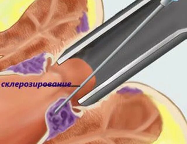 Склеротерапия внутренних геморроидальных узлов. Склерозирование геморроя. Малоинвазивное лечение геморроя