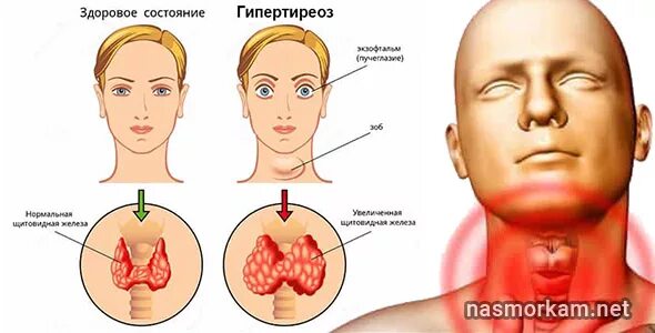 Болит гортани при надавливании. Болит гортань при глотании.