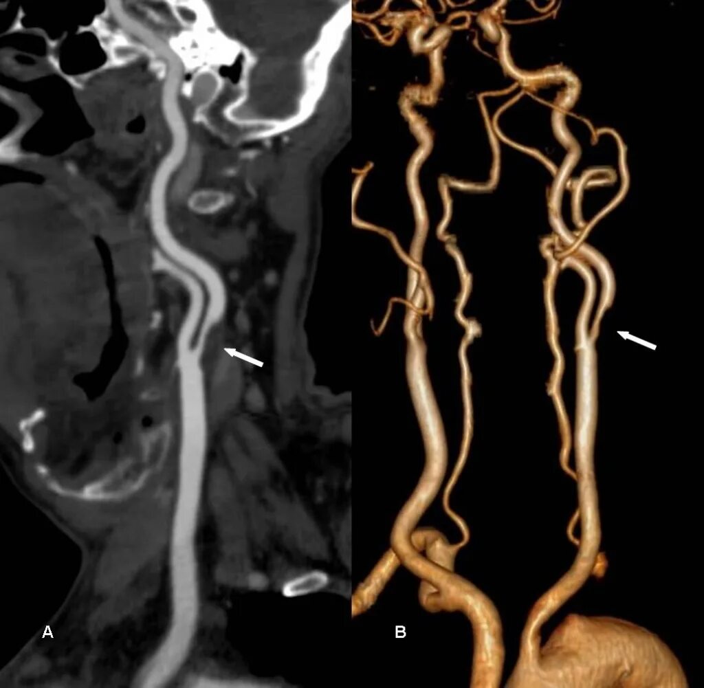 Стеноз устья вса. Стеноз внутренней сонной артерии кт. Кт ангиография сонных артерий. Диссекция внутренней сонной артерии кт. Аневризма внутренней сонной артерии кт.