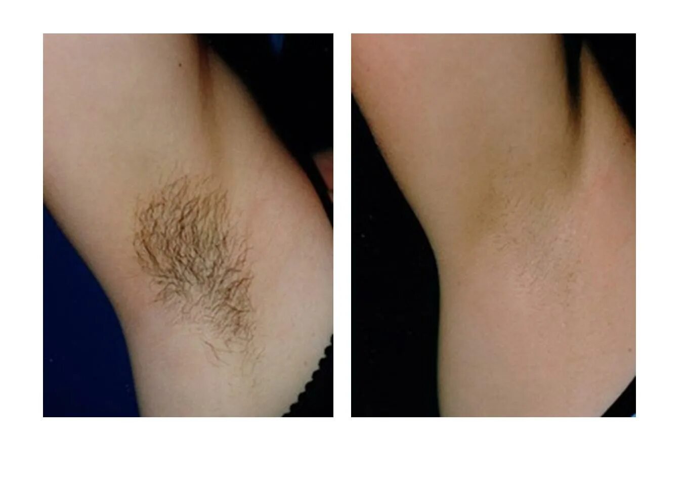 Волос отращивать шугаринг. Лазерная эпиляция до и после. Подмышки до и после лазерной эпиляции. Лазерная депиляция подмышек до и после.