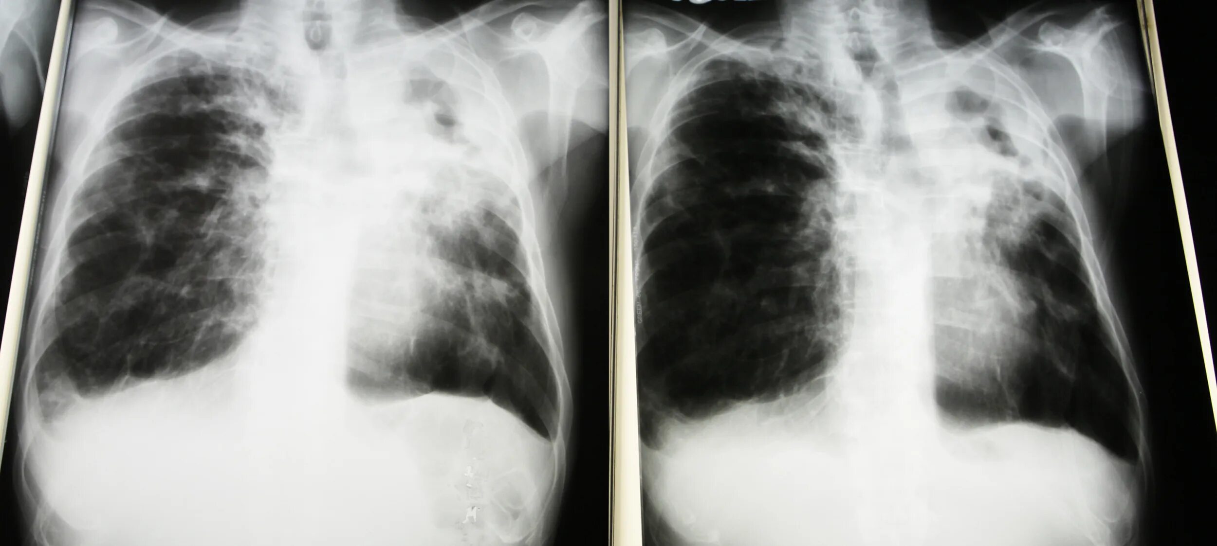 Рентген снимок при туберкулезе легких. Рентген легких больного туберкулезом. Туберкулез легких рентген. Снимки легких при туберкулезе.