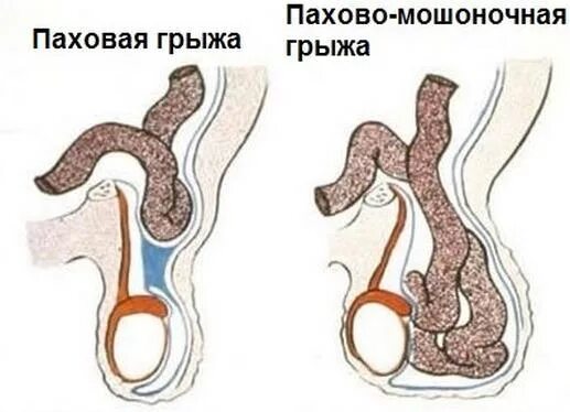 Ответы Mail.ru: ПОмогите .Что то непонятное в мошонке над левым яйцом