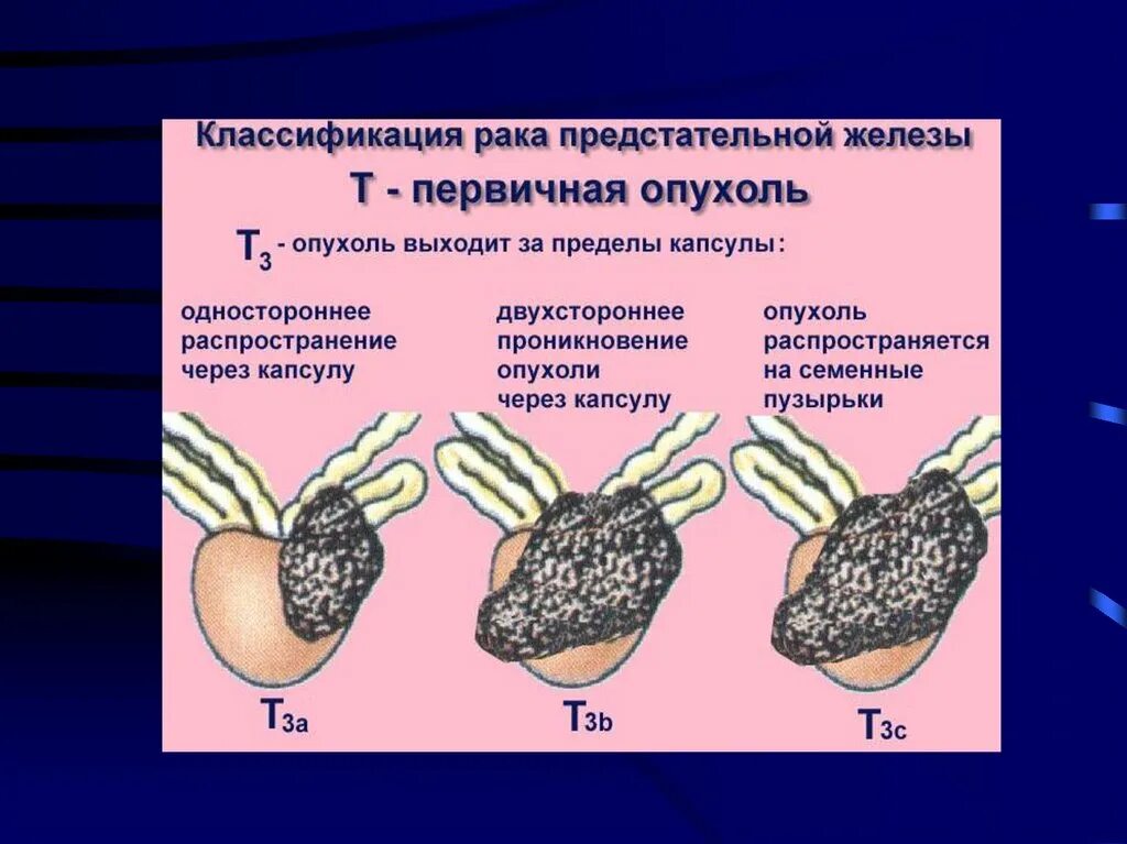 Стадии предстательной железы прогноз. Опухоли простаты классификация. Что такое РПЖ предстательной железы. Онко предстательной железы. Стадии злокачественных опухолей простаты.