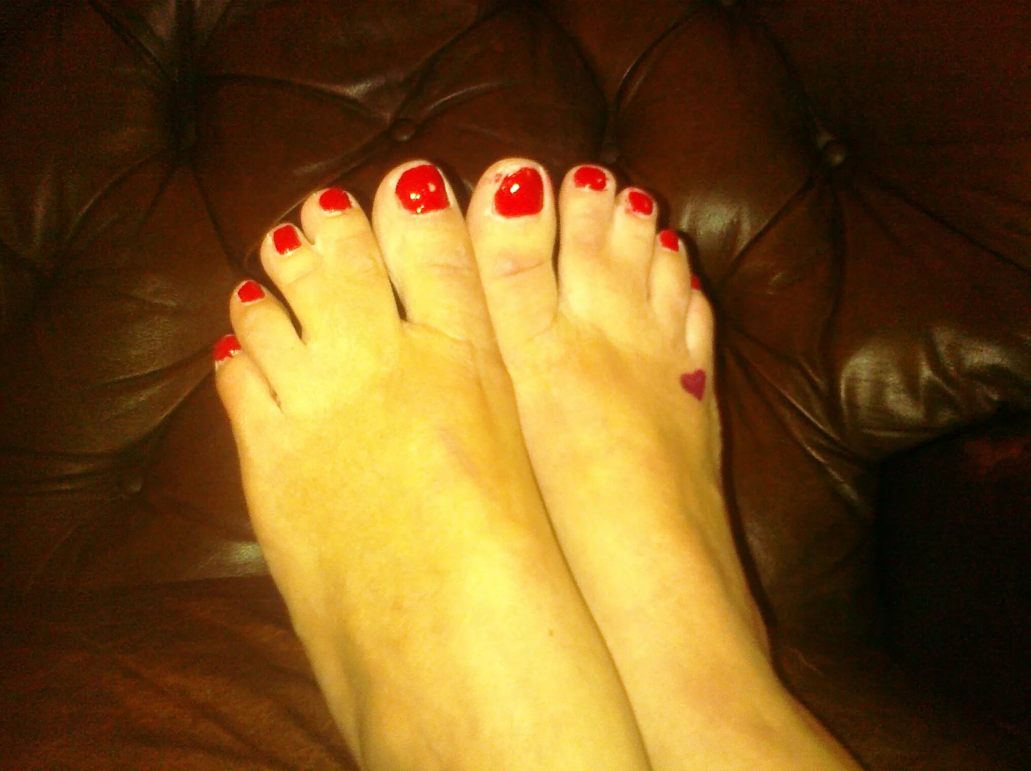 Синдактилия 2-3 пальцев стоп. Синдром смита-лемли-опитца. Синдактилия сращение пальцев. Сросшийся мизинец на ноге. Синдактилия пальцев стопы.