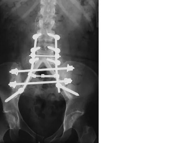 Остеосинтез позвоночника транспедикулярной. Остеосинтез позвоночника рентген. Остеосинтез при переломе позвоночника. Транспедикулярная фиксация позвоночника рентген. Операция фиксация позвоночника