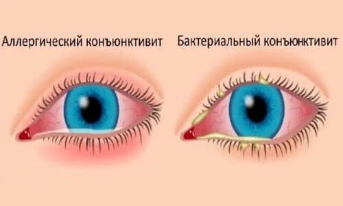 Ретикулин глазные капли. Капли для глаз антибактериальные и противовоспалительные. Глазные капли антибактериальные. Коньюктивит глаз лекарство. Коньюктивит глаз лекарство.