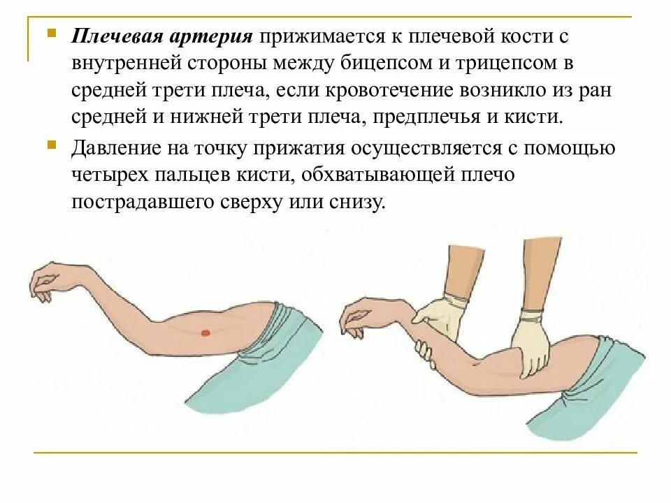 Плечевая артерия кровотечение. Нижняя треть плеча кровотечение. Кровотечение предплечья. Плечевая артерия прижимается при кровотечении. Прижмитесь правой стороной