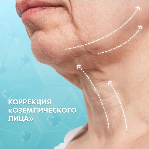 Оземпическое лицо фото до и после