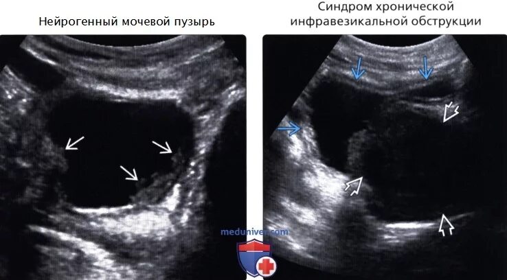 Трабекулярная стенка мочевого пузыря узи. Трабекулярный мочевой пузырь. Опухоль мочевого пузыря цистоскопия. Дивертикул стенки мочевого пузыря. Трабекулярный мочевой пузырь.