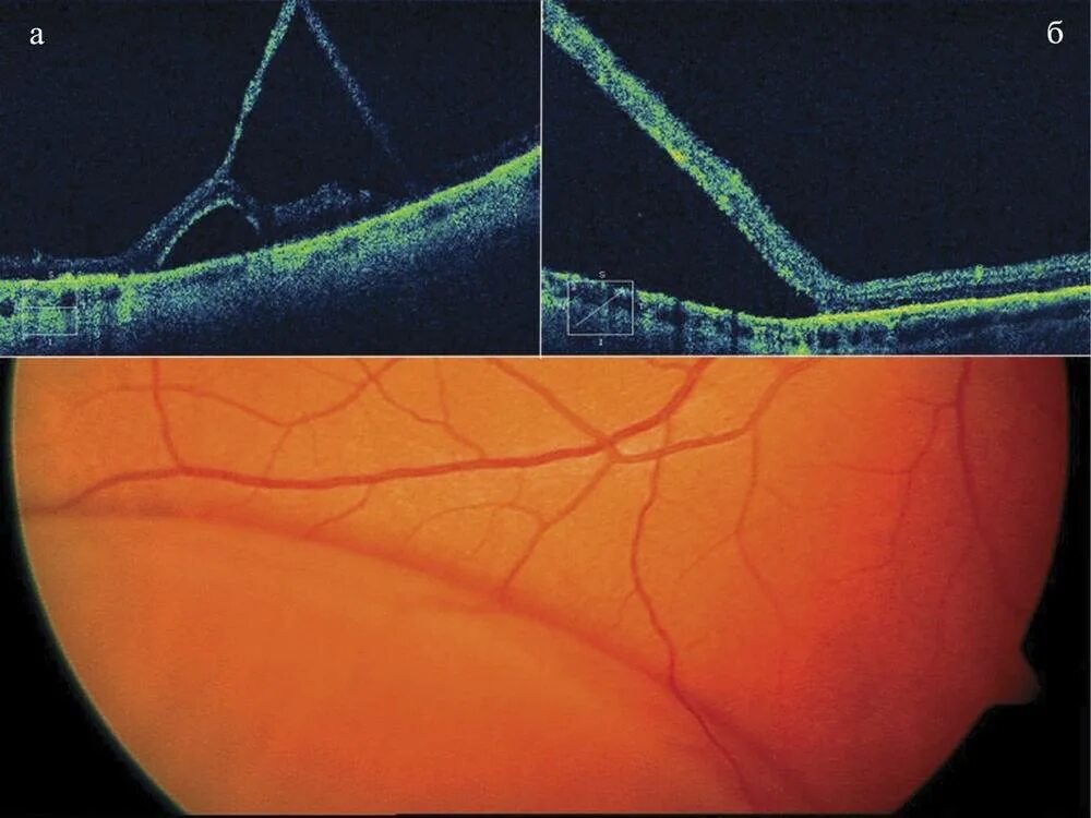 Макулярный разрыв после операции. Ретиношизис дистрофия сетчатки. Макулярный ретиношизис сетчатки. Пузыревидный ретиношизис. Ювенильный ретиношизис.
