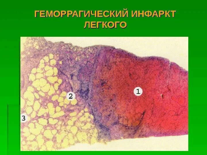 Геморрагический инфаркт лёгкого препарат. Геморрагический инфаркт легкого микропрепарат. Геморрагический инфаркт легкого. Геморрагический инфаркт легкого патанатомия макропрепарат. Геморрагический инфаркт легкого препарат.