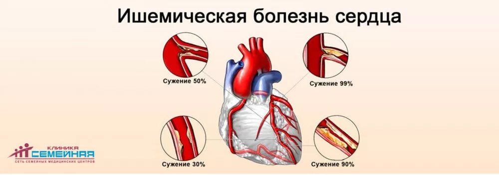 Ишемия боковой. Ишемическая болезнь сердца клиника. Ишемичкскаяболезнь сердца. Ишемическая болезнь сердца рисунок.