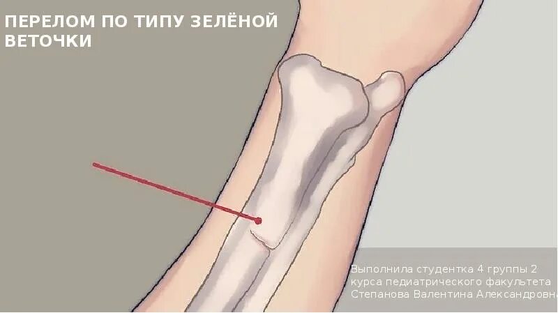 Перелом типа ветки. Перелом по типу зеленой веточки у детей. перелом по типу зеленой ветки. поднадкостничный перелом рентген. перелом зеленой веточки.
