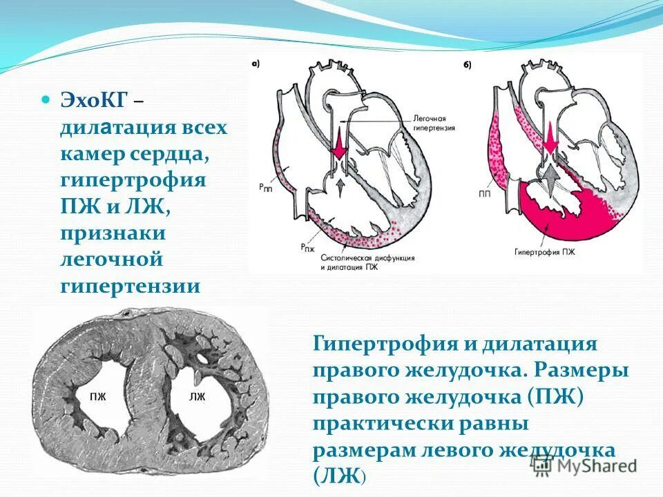 Желудочка сердца расширена. Гипертрофия правого желудочка ЭХОКГ. Тоногенная дилатация левого желудочка. Дилатационная гипертрофия правого желудочка. Расширение полостей сердца дилатация.