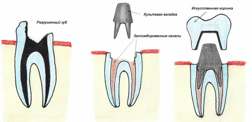 Штампованная коронка препарирование. Культевая вкладка и коронка схема. Как устанавливаютсякоронки на щубы. Препарирование мостовидного протеза. Как устанавливается коронка на зуб.