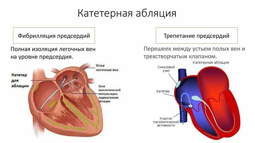 Где делают абляцию. Абляция фибрилляции предсердий. Катетерная абляция фибрилляции предсердий. Радиочастотная катетерная абляция (РЧА). Радиочастотная катетерная изоляция устьев легочных вен.