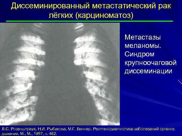 Рак молочной железы метастазы в легких