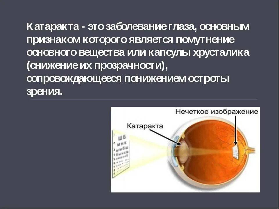 Факосклероз глаз что это такое. Катаракта хрусталика глаза. заболевание катаракта. симптомы катаракты глаза.