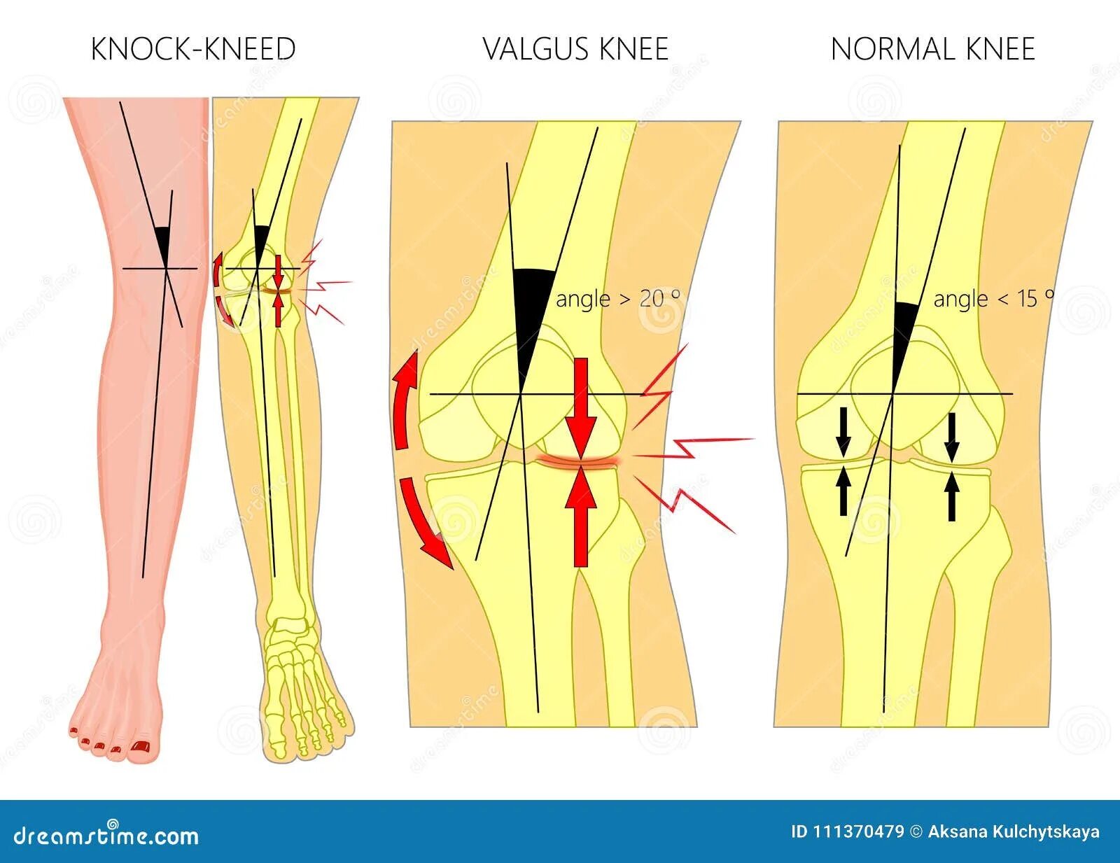 Колено стучит. Вальгус коленных суставов. Knee вальгус. Динамический вальгус колена.