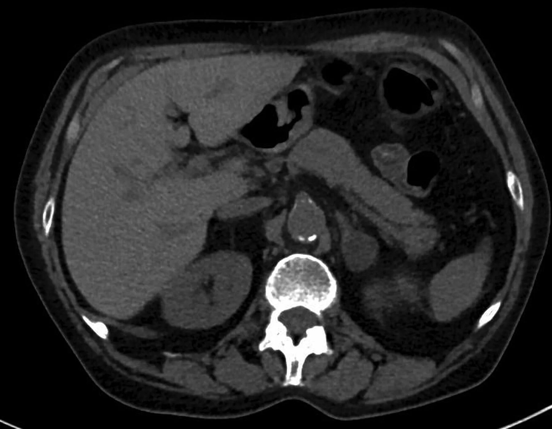 Аденома надпочечника у мужчин что это. Adrenal adenoma CT. Инциденталома надпочечника на кт. Инциденталома правого надпочечника что это такое.