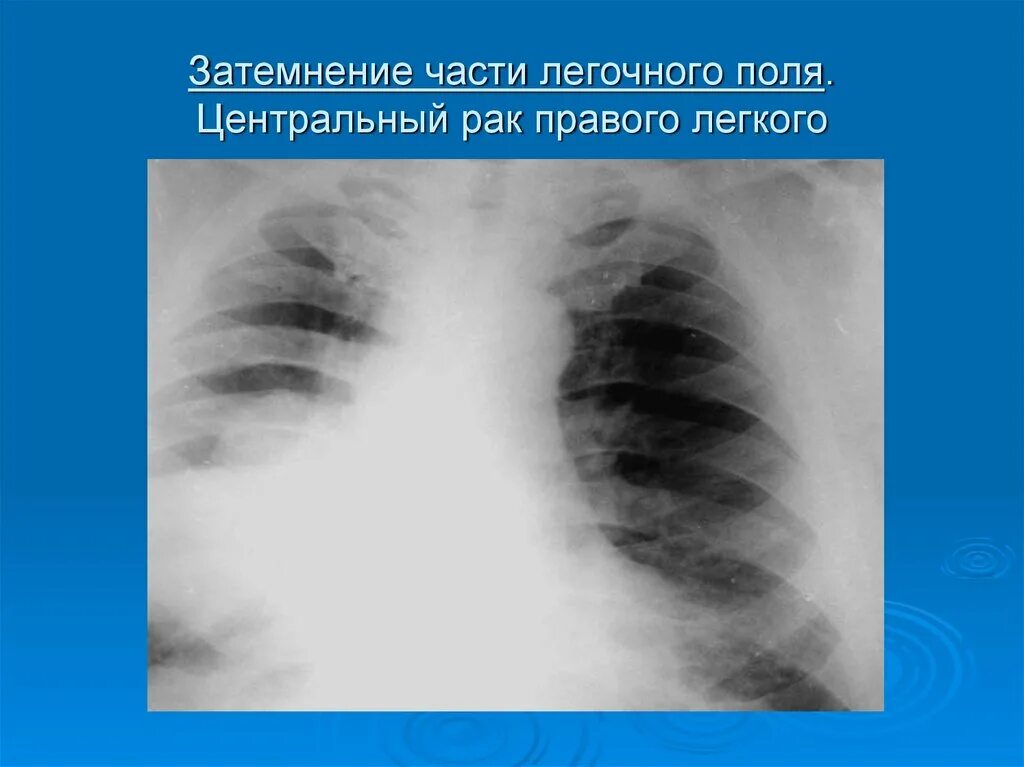 Центральный рак правого. Затемнение легочного поля. Центральная опухоль легкого. Онкология правого легкого. Центральная опухоль правого легкого.