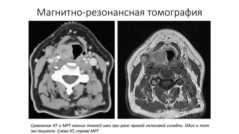 Кт и мрт гортани