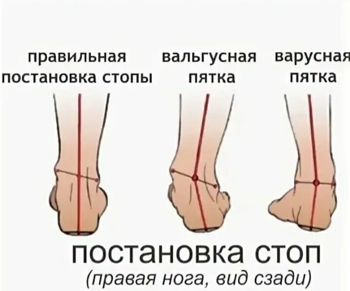 Вальгусная стопа у взрослых операция. Варусная деформация малоберцовой кости. Вальгусная деформация бедренной кости. Вальгусная деформация 1 пальца правой стопы.