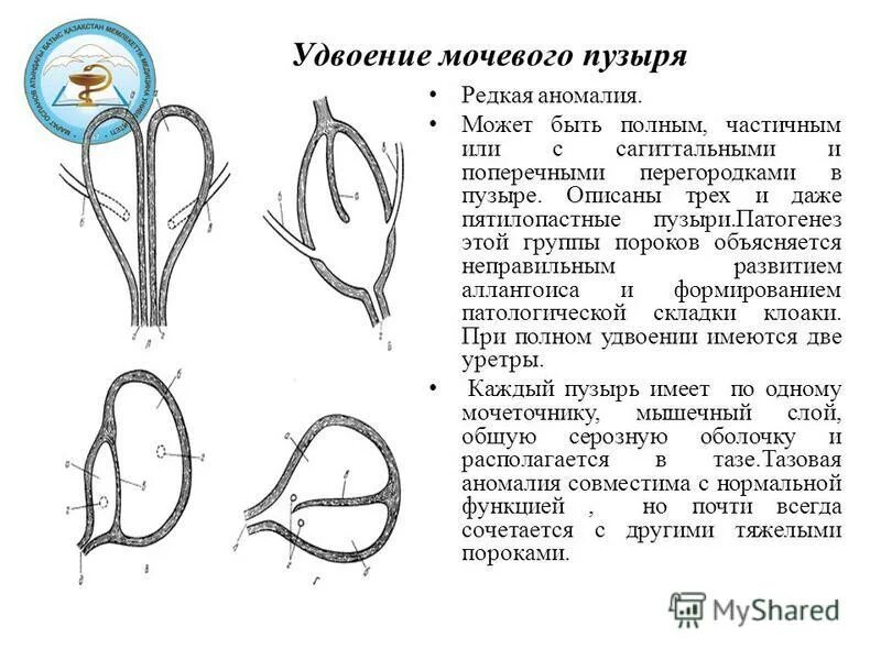 Аномалия мочевого. Аномалии и пороки развития мочевого пузыря. Аномалия развития почек удвоение. Удвоение мочевого пузыря. Аномалии мочевого пузыря классификация.