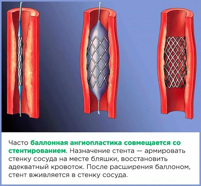 Инфаркт коронарное стентирование. Чрескожная ТРАНСЛЮМИНАЛЬНАЯ баллонная коронарная ангиопластика.. Стентирование коронарных артерий. Баллонная ангиопластика и стентирование артерий сердца. Операция стентирование сосудов сердца.