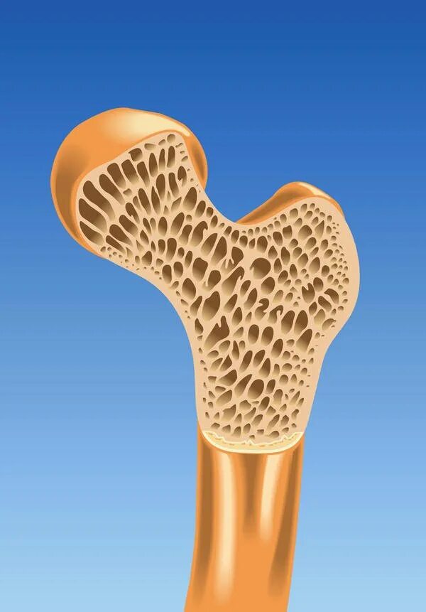 Остеопороз. Здоровые кости. Пористая кость. Пористые кости болезнь.