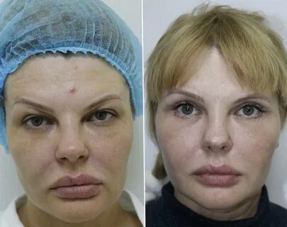 Нити аптос для подтяжки лица: отзывы, цена, фото до и после, aptos visage и друг