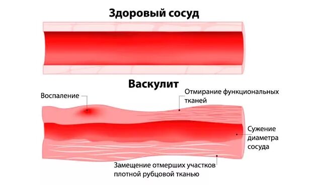 Воспалительные поражения сосудов - васкулиты. Воспаление стенок сосудов это васкулит?. Геморрагический васкулит сосудов. Уртикарный васкулит патогенез. Сужение сосудов руки