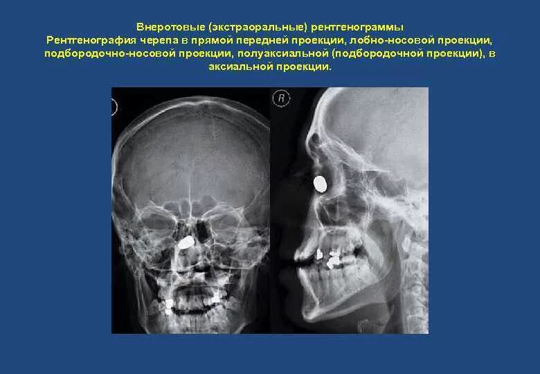 Аксиальная проекция челюсти. Лобно носовая проекция рентген. полуаксиальная проекция рентген. рентгенография черепа в подбородочно носовой проекции. рентгенография черепа в полуаксиальной проекции.