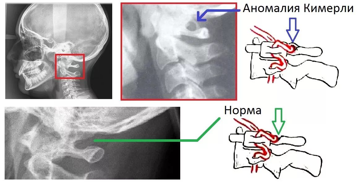 Аномалия это простыми. Аномалия Киммерле Атланта. Аномалия Киммерли в шейном отделе позвоночника рентген. Аномалия Киммерли доктор Мясников.